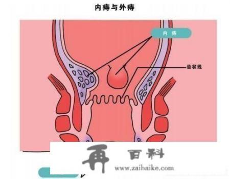 痔疮是怎么来的_受法律保护的影片