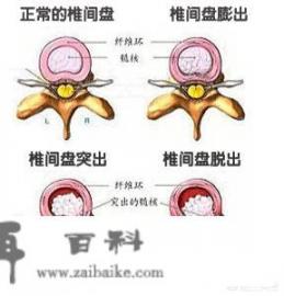 校园时期的暧昧，你有吗_腰椎膨出坚持吊单杠真的有用吗