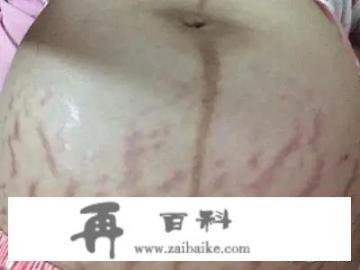 妊娠纹需要预防吗？是把那些油抹在肚子上吗？那对宝宝有影响吗