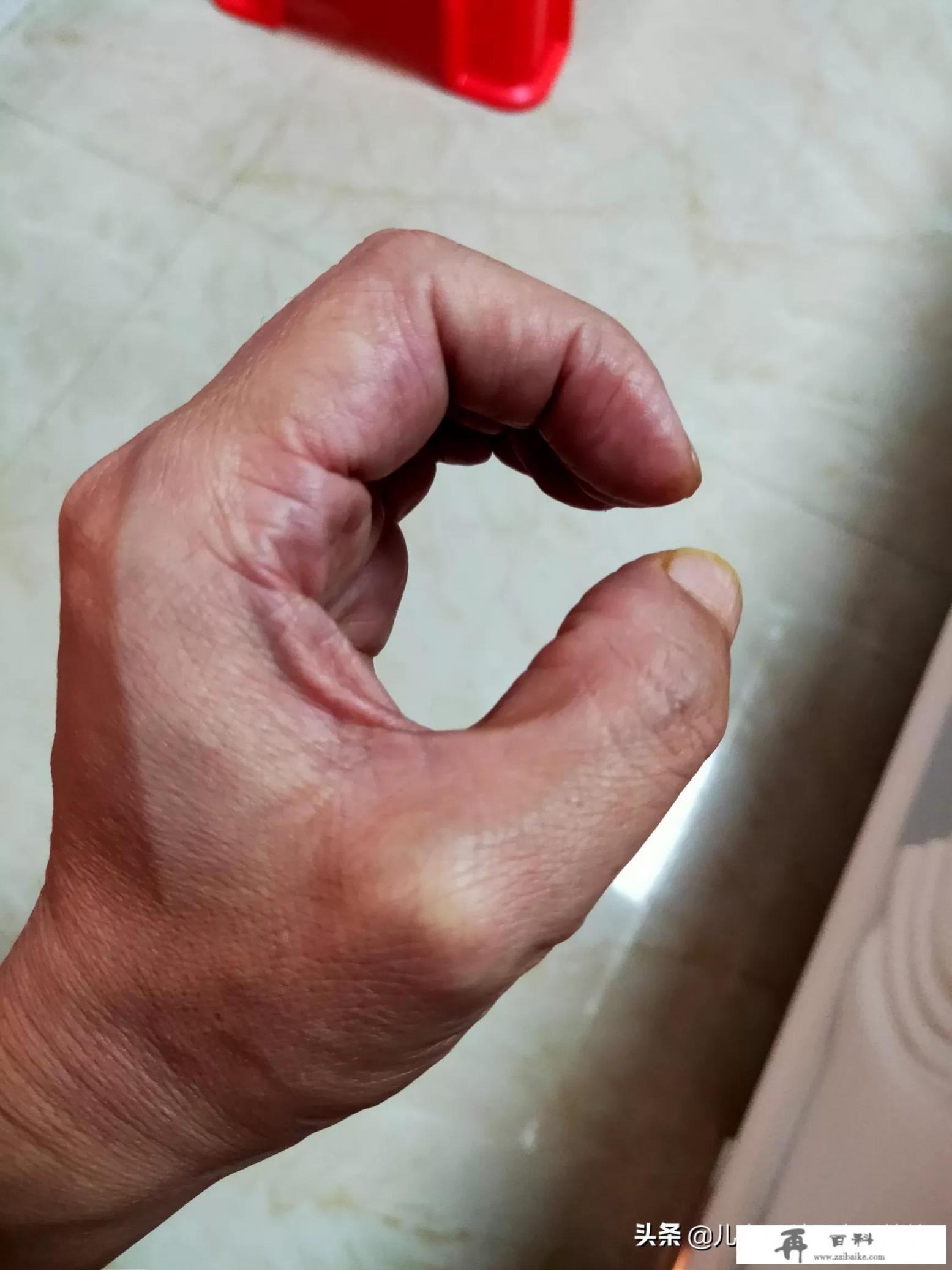 腰椎盘突出怎么治？