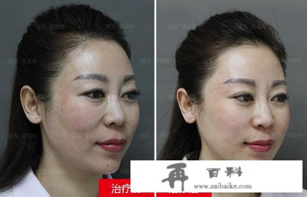 手术去除眼部皱纹多少钱？