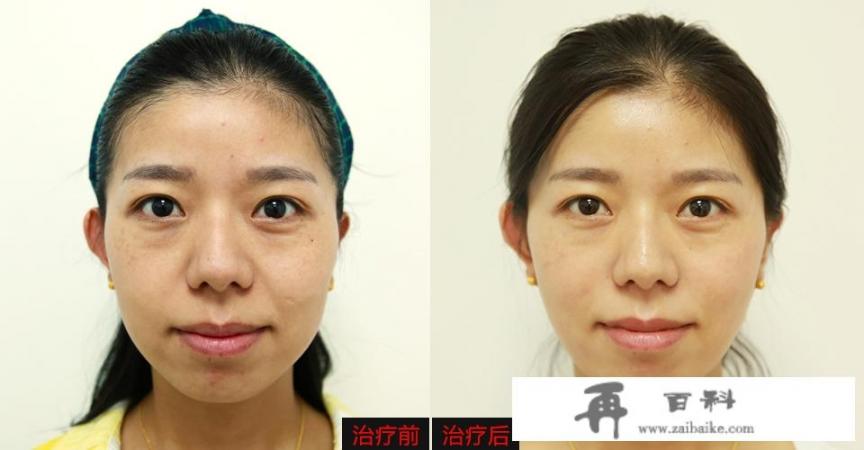 手术去除眼部皱纹多少钱？