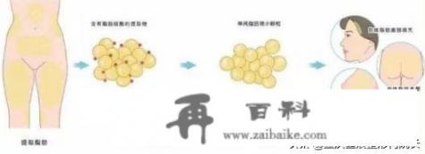自体脂肪填下巴效果好吗？
